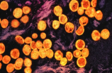 多国报告出现的猴痘是什么疾病?