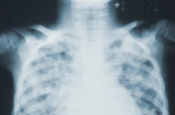 肺炎支原体阳性：治疗方法、症状及预防